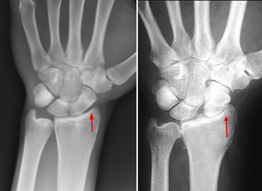 Rheumatoid Wrist